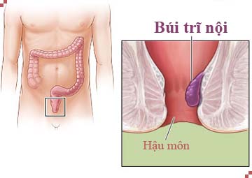 Trĩ nội xuất hiện do nhiều nguyên nhân