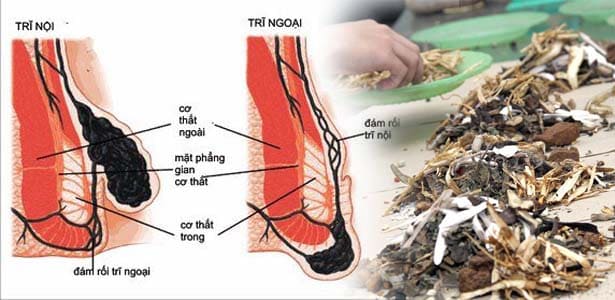 Hiệu quả cao trong điều trị trĩ nhẹ đến trung bình