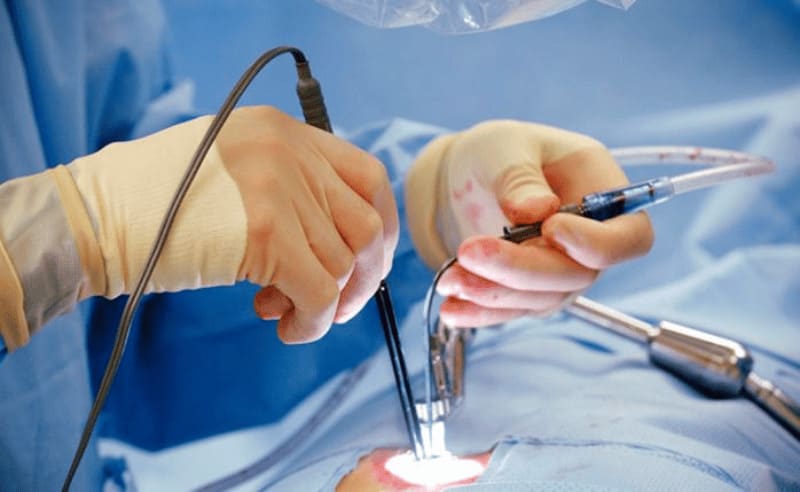 Điều trị trĩ bằng phương pháp ngoại khoa, thủ thuật cắt trĩ