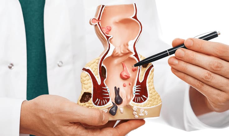 Lưu ý khi chữa bệnh trĩ để đạt hiệu quả