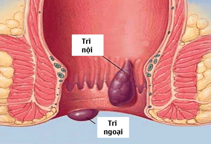 Định nghĩa bệnh trĩ nội