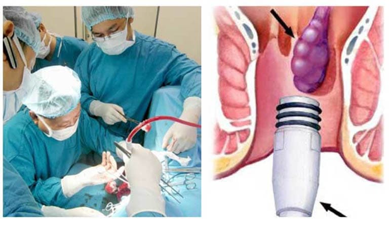 Thực hiện các thủ thuật chữa trĩ nội không phẫu thuật