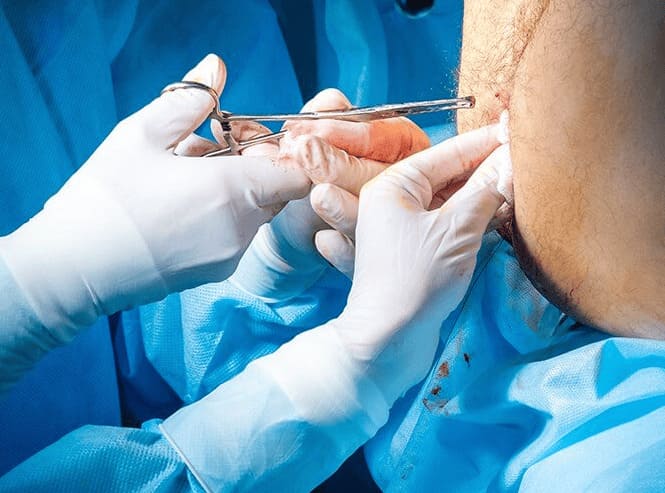 Thực hiện phẫu thuật cắt bỏ búi trĩ