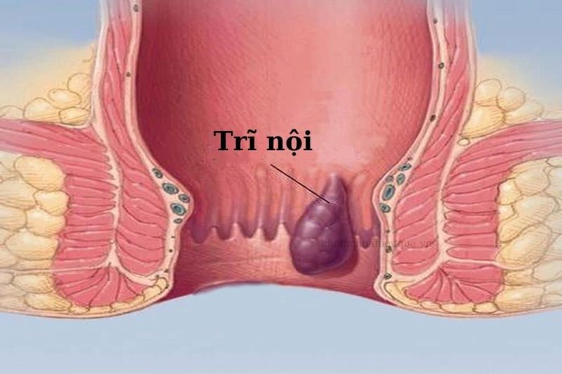 Bệnh trĩ nội