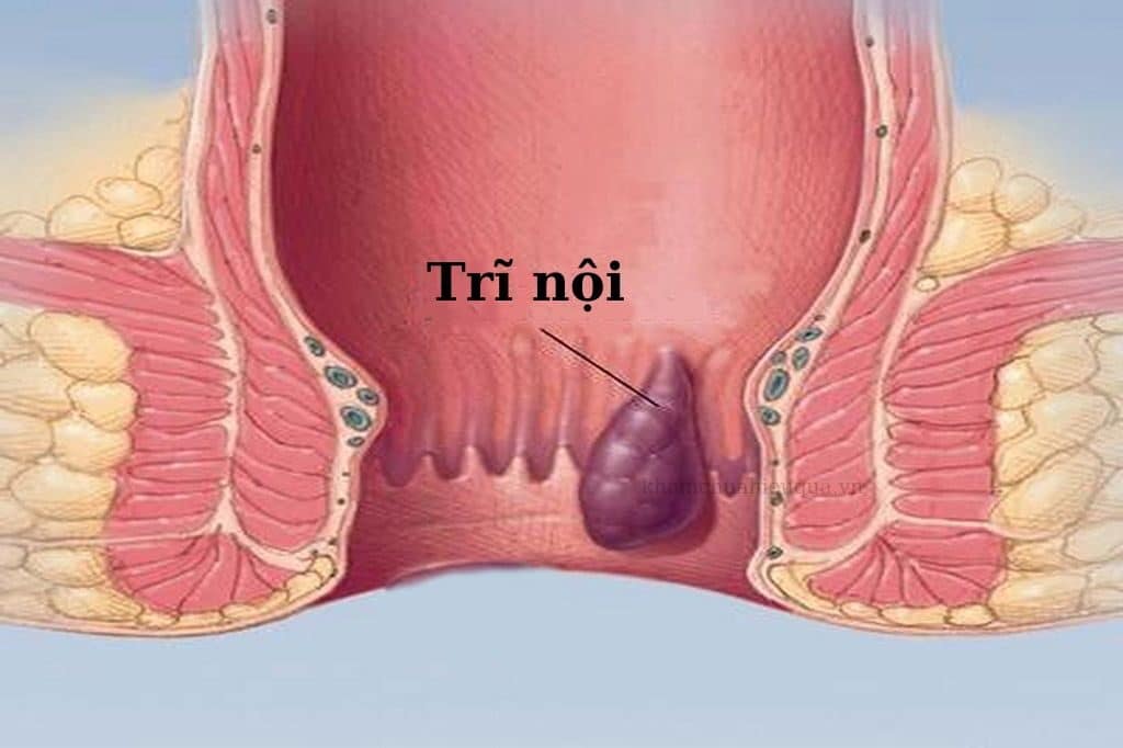 Bệnh trĩ nội