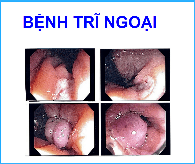 Bệnh trĩ ngoại