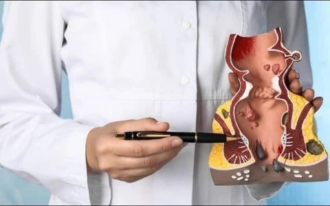 Lý giải nguyên nhân bệnh trĩ tái phát dù đã được điều trị