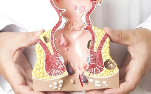 Giới thiệu và tầm quan trọng của việc nhận biết bệnh trĩ tái phát từ sớm