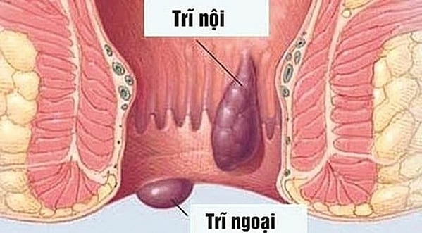 Trĩ là bệnh lý như thế nào?