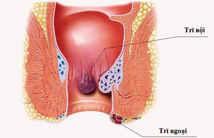 Tổng quan về bệnh trĩ