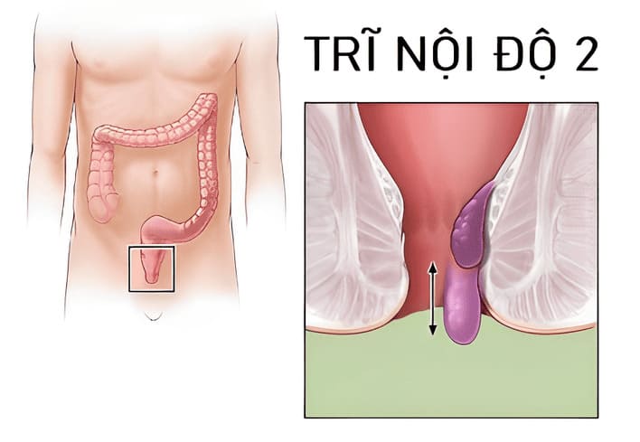 Bệnh trĩ nội ở cấp độ 2 trở lên