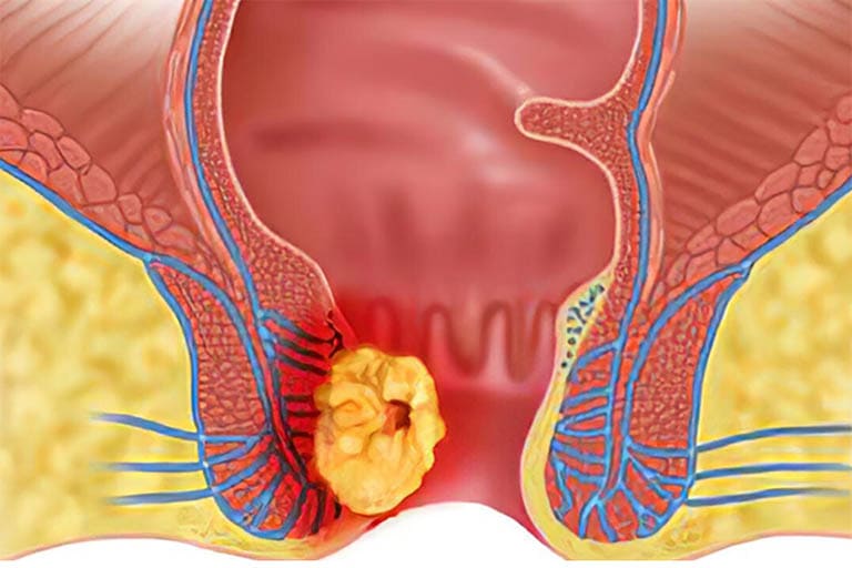 Búi trĩ nhiễm khuẩn