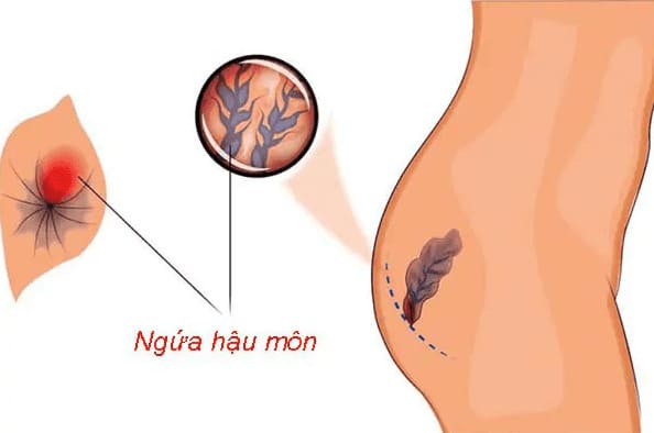 Triệu chứng sau sinh bị trĩ nội là gì?
