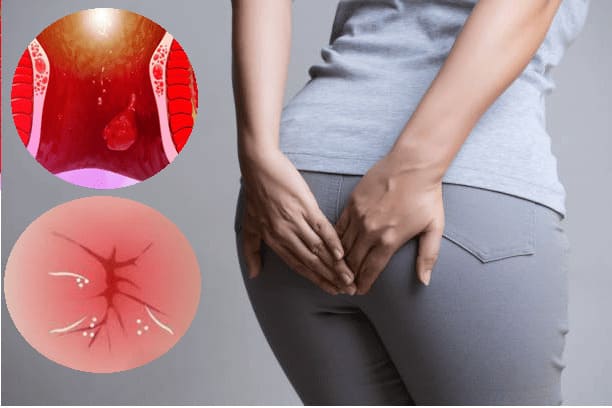 Nguyên nhân dẫn đến tình trạng sau sinh bị trĩ nội