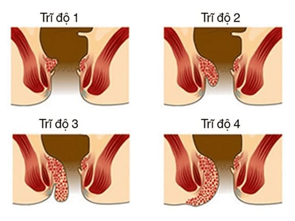 Khi nào có thể thực hiện thắt trĩ nội?