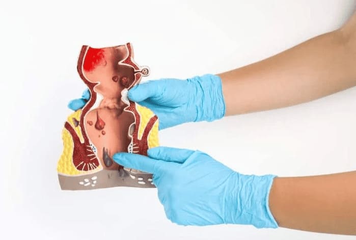 Thắt trĩ nội có đau không? Bao lâu thì rụng?