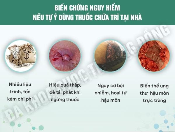 Đâu mới là kỹ thuật chữa trĩ tiên tiến mà mọi người nên lựa chọn?