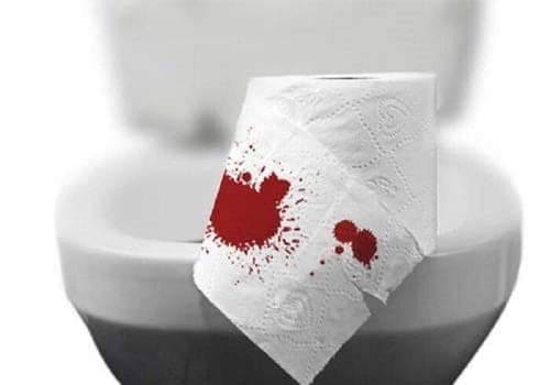 Nhận diệu triệu chứng bệnh trĩ ngoại