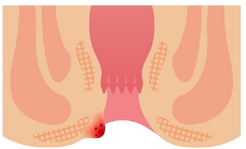 Trĩ ngoại độ 1