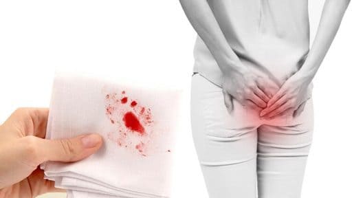 Điểm danh những triệu chứng điển hình của trĩ ngoại độ 1