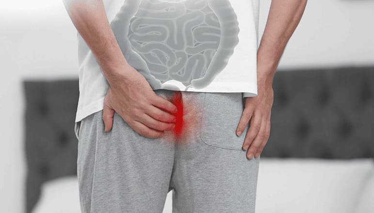 Trĩ ngoại độ 3 để lâu có nguy hiểm không?