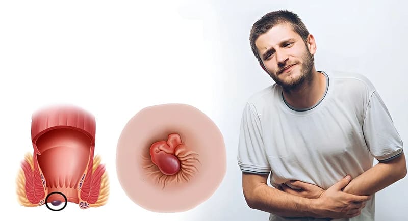 Cảnh báo mức độ nguy hiểm nghiêm trọng khi mắc trĩ ngoại độ 4