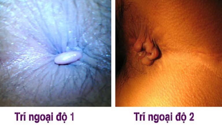 Trĩ ngoại giai đoạn đầu: đặc điểm và dấu hiệu nhận biết