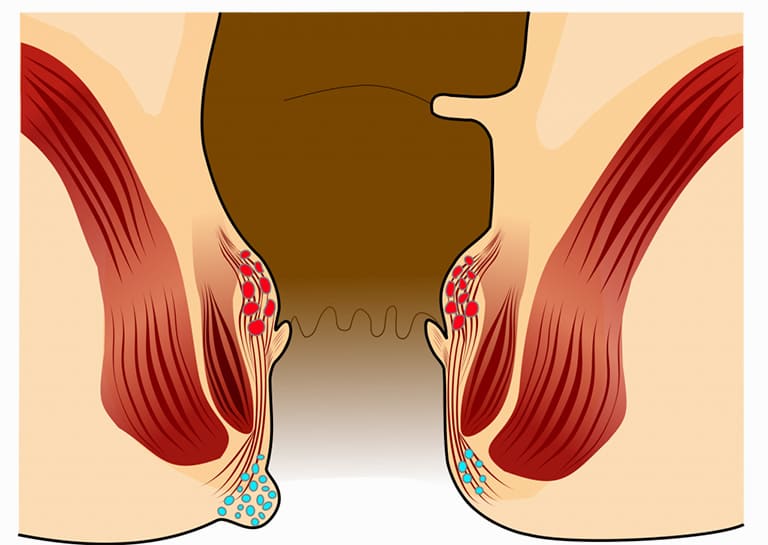 Trĩ ngoại giai đoạn đầu là gì?