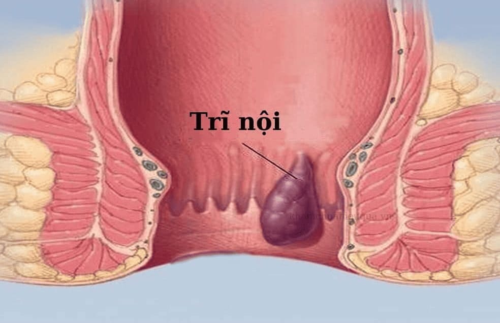 Sơ lược về bệnh trĩ nội