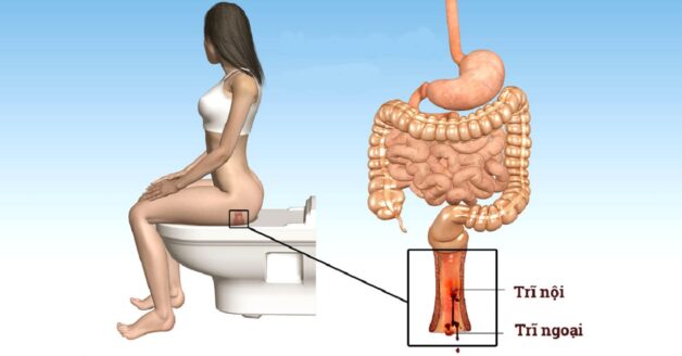 Có nên áp dụng cách chữa bệnh trĩ tại nhà không?