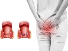 Bệnh trĩ là bệnh lý như thế nào ?