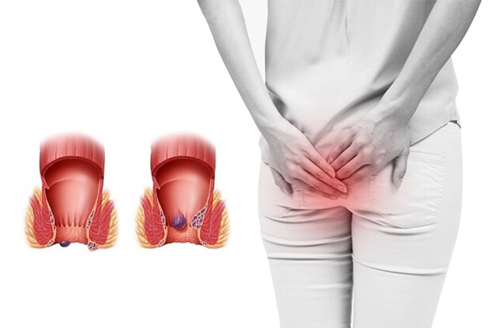 Bệnh trĩ là bệnh lý như thế nào ?