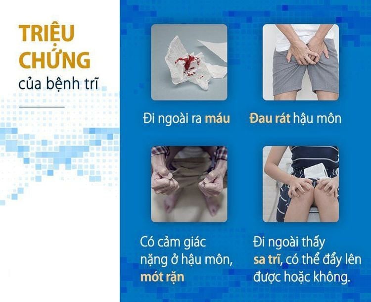 Nhận diện các triệu chứng khi mắc trĩ