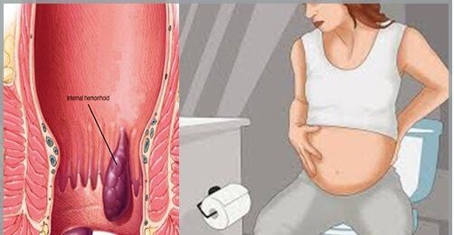 Liệu bệnh trĩ có bầu được không ? Ảnh hưởng của bệnh trĩ đối với bà bầu