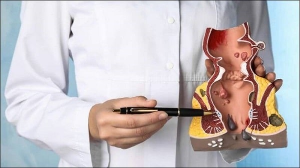 Hiểu rõ khái niệm và nguyên nhân khiến trĩ hình thành