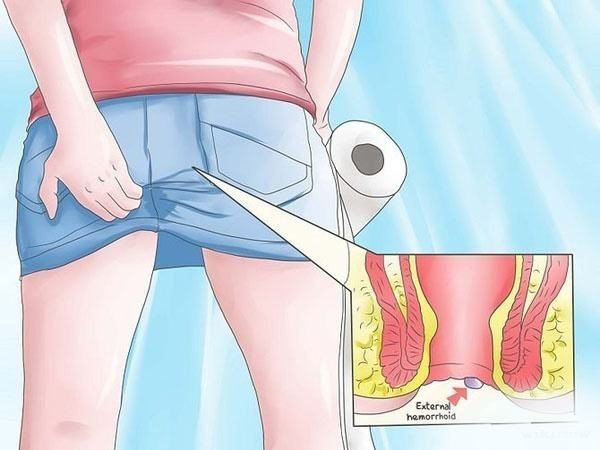 Có nhất thiết phải phẫu thuật cắt búi trĩ không ?