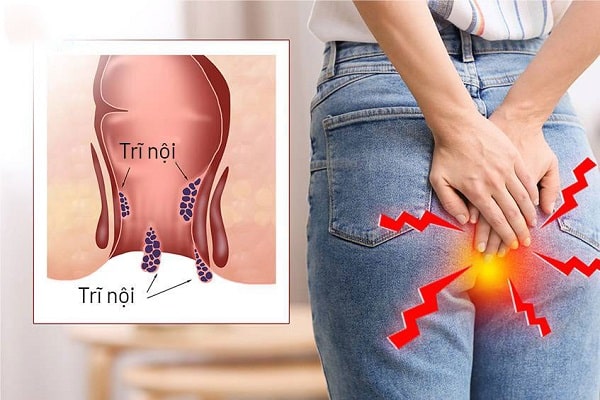 Tìm hiểu về bệnh trĩ