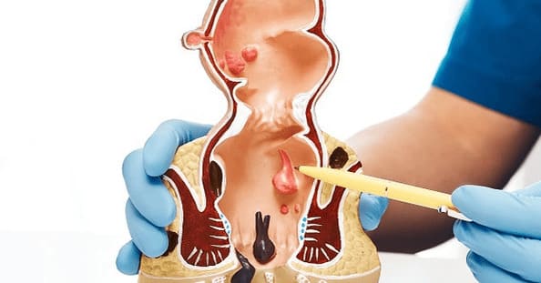 Làm giảm đau trĩ nội với phác đồ điều trị y khoa
