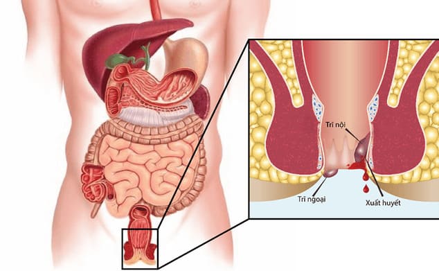 Triệu chứng của bệnh trĩ nội