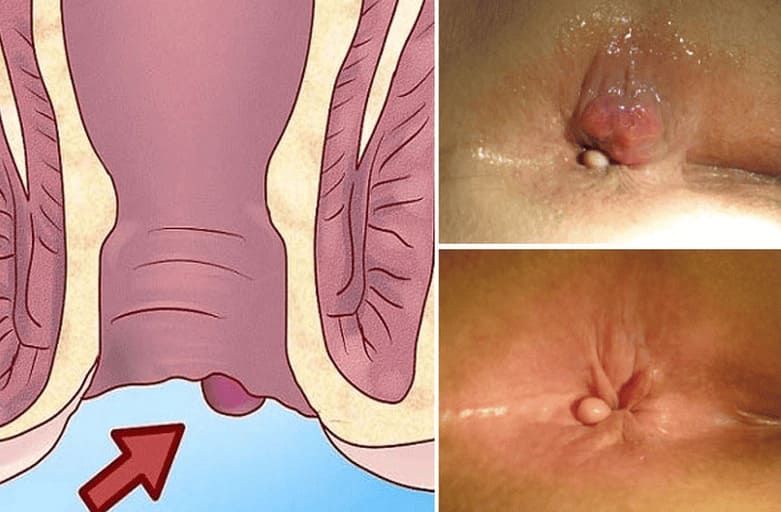 Nhận biết bệnh trĩ ngoại