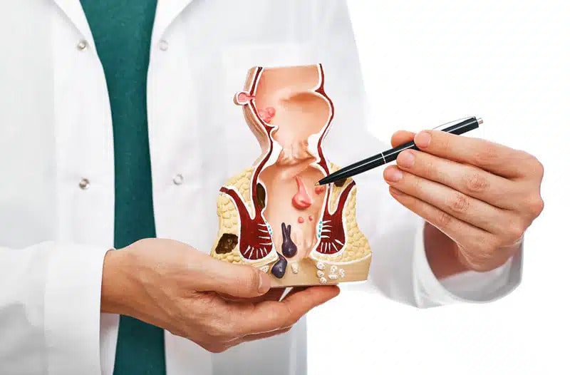 Nên hay không khám bệnh trĩ tại các bệnh viện lớn ở Hà Nội ?