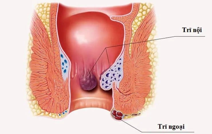 Bệnh trĩ nội là gì?