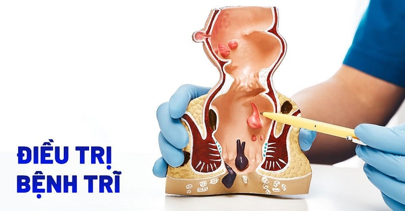 Các biện pháp chăm sóc tại nhà giúp rút ngắn thời gian điều trị bệnh trĩ
