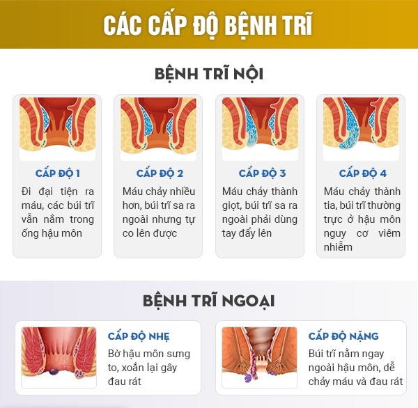 Hiểu về bệnh trĩ và phân loại bệnh trĩ