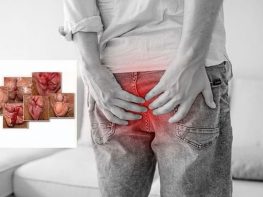 Bệnh trĩ ngoại nặng