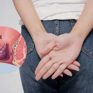 Cách làm giảm đau trĩ nội
