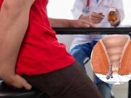 Tắc mạch trĩ ngoại