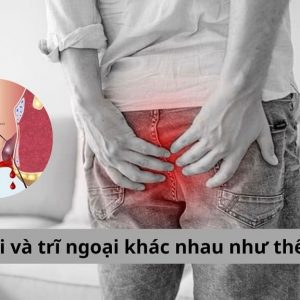 Trĩ nội và trĩ ngoại khác nhau như thế nào?