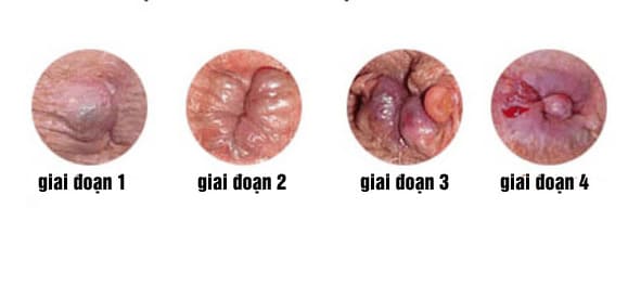 Dấu hiệu trĩ ngoại qua từng giai đoạn cần chú ý
