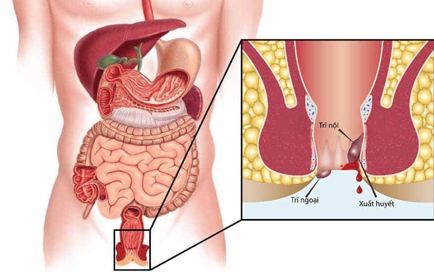 Bệnh trĩ ngoại nặng có nguy hiểm không?